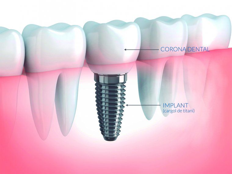 Un implant dental consisteix en introduir un cargol de titani en l'os per suplir les arrels de les dents que falten
