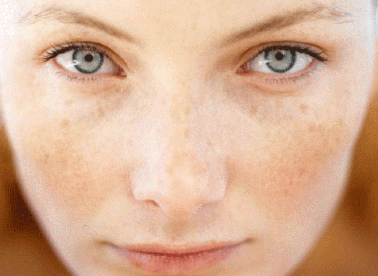 Saps com i quan eliminar les taques solars de la pell? Saps com i quan eliminar les taques solars de la pell?