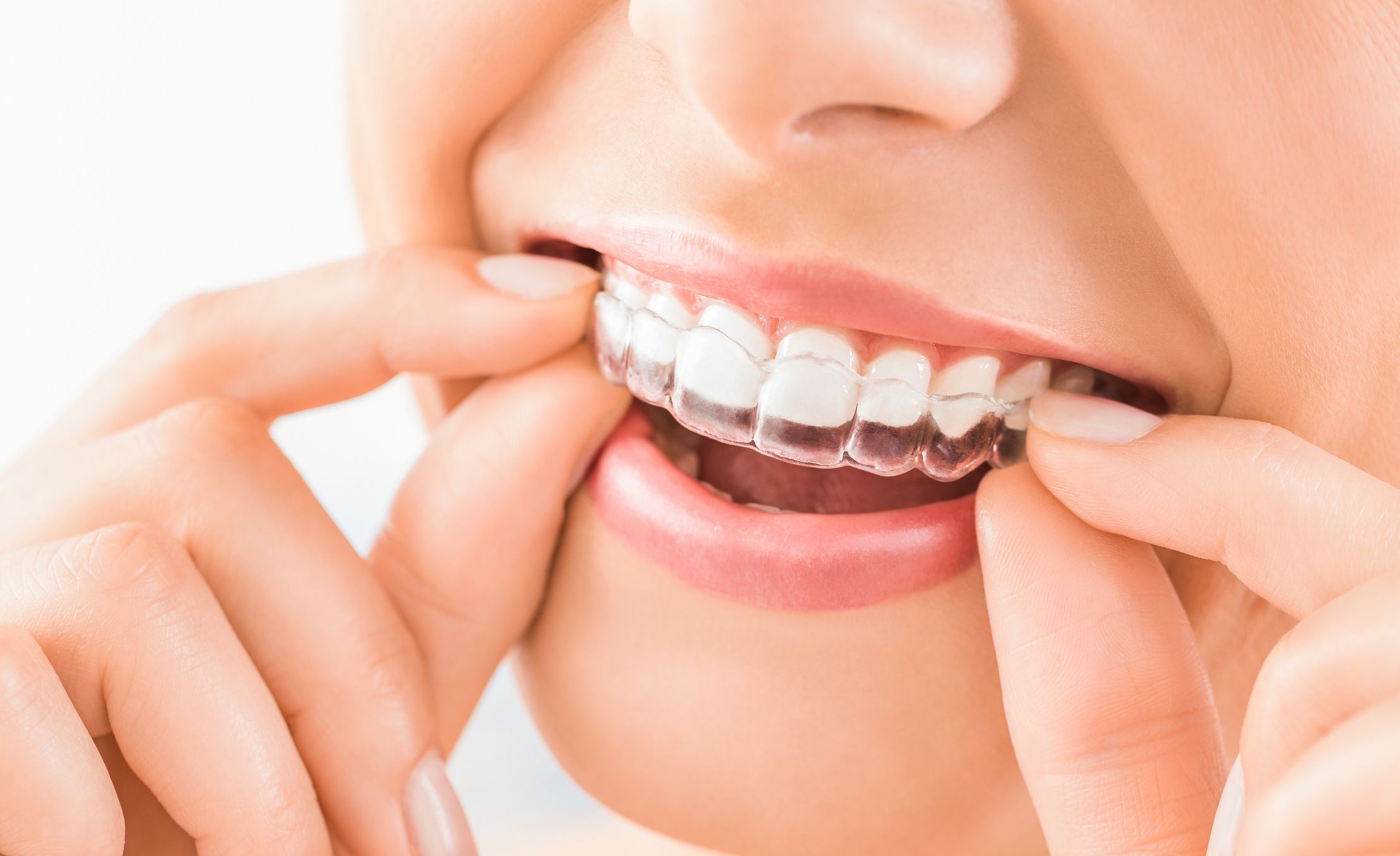 Així és el tractament d'ortodòncia invisible anomenat Invisalign® FOTO: Cedida