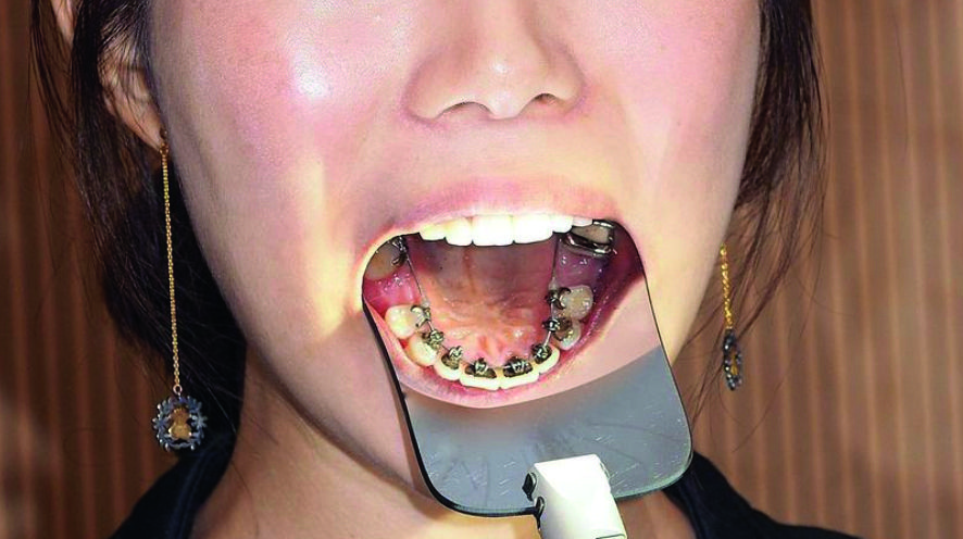 Ortodòncia lingual és un dels tractaments d'Ortodoncia Sant Cugat. FOTO: Cedida