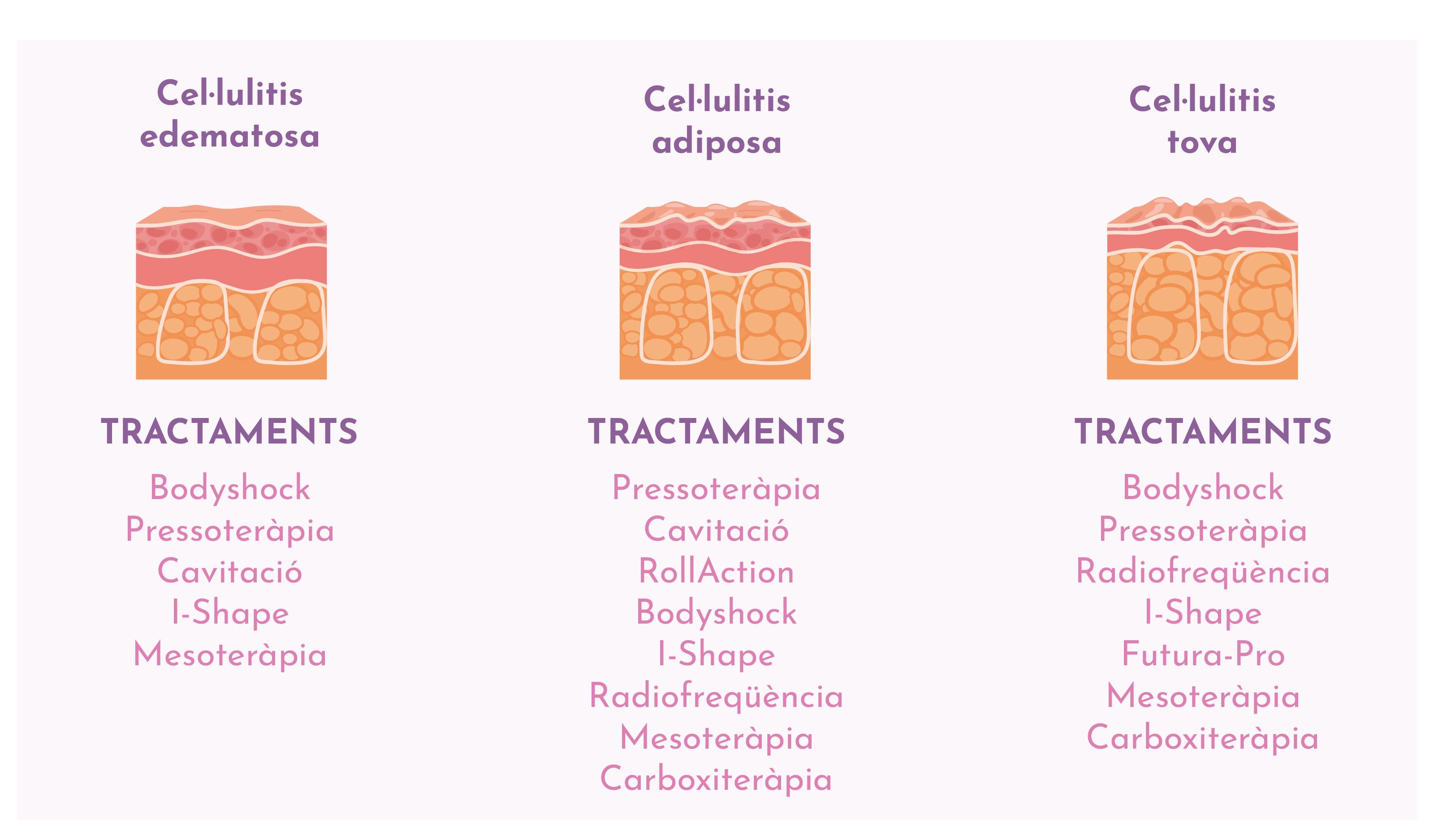 Tractaments cel lulitis Grup policlinic