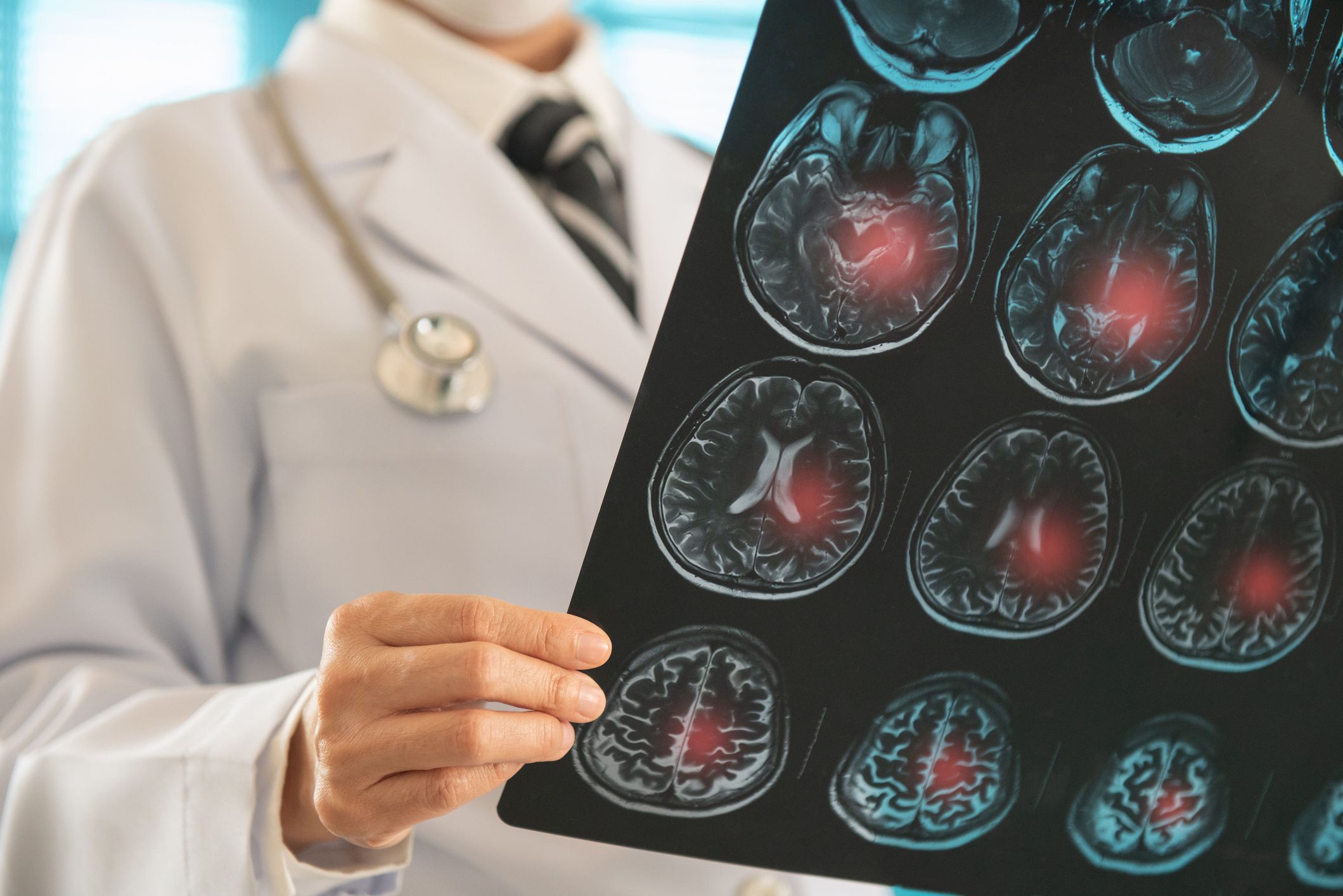 A l'Estat espanyol, més de 100.000 persones pateixen anualment un ictus FOTO: Cedida